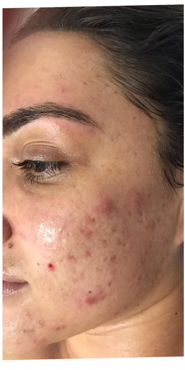Antes do tratamento — pele com acne ativa